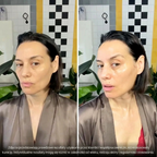 BioInfusion+ | Włoski system mikroinfuzji