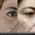 BioInfusion+ | Włoski system mikroinfuzji